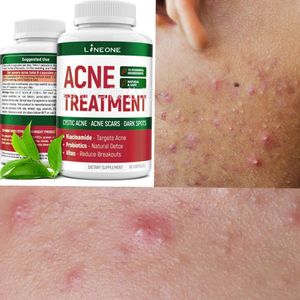 Hormonal & Cystic Acne Supplement Zinc, Niacinamide Clear Skin Pills Acne Treatment Vegan - 60 Capsules