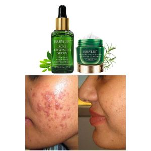 Breylee Pimple & Acne Removal Tea Oil Set - 2 In 1