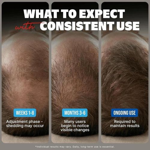 product_image_name-Kirkland Minoxidil-5% For Men Hair Regrowth Treatment Topical Solution - 6 Month Supply-3