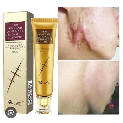 product_image_name-Pei Mei-TCM Scar And Acne Mark Removal Ointment Gel 30g-1
