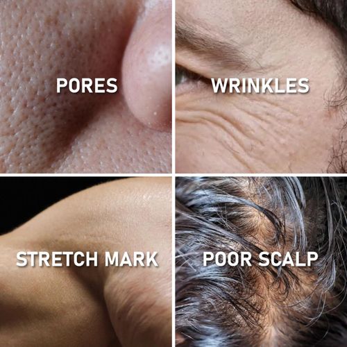 product_image_name-Generic-1.5mm Derma Roller Microneedle Roller For Home Use, Includes Storage Case -3