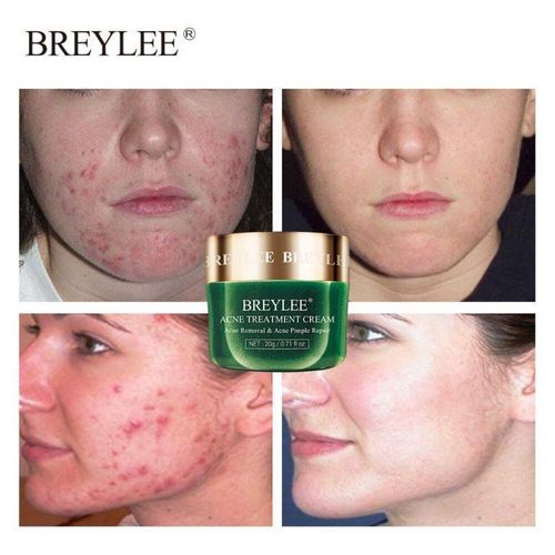 product_image_name-Breylee-Acne Pimple Face Skin Care Treatment  Cream - 20g-1