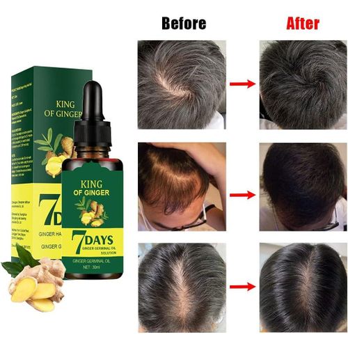 product_image_name-Ginger-Germinal Faster Hair Growth Oil - 30mls-1