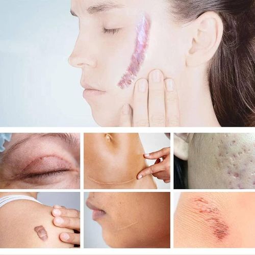 product_image_name-Skin Solution- Yoxier Lavender Scar Repair Cream – Remove Scars, Acne Marks, Anti-Inflammatory – 20g-4