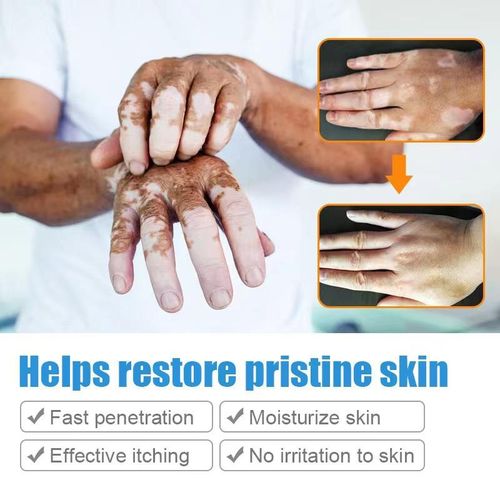product_image_name-Generic-Vitiligo Ointment White Spot Cream Sweaty White Spotted Skin Ointment-5