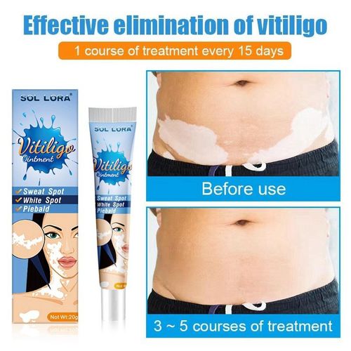 product_image_name-Generic-Vitiligo Ointment White Spot Cream Sweaty White Spotted Skin Ointment-6