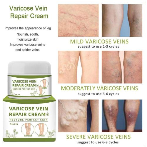 product_image_name-Generic-Varicose Vein Cream Spider Varicose Vein Cream Improves Blood-1